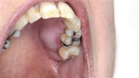 How To Drain Tooth Infection Best Drain Photos Primagemorg