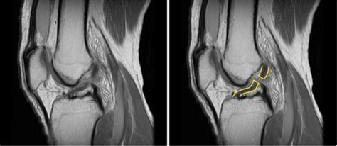 Ligament Injuries And Acl Reconstruction Dr Bu Balalla