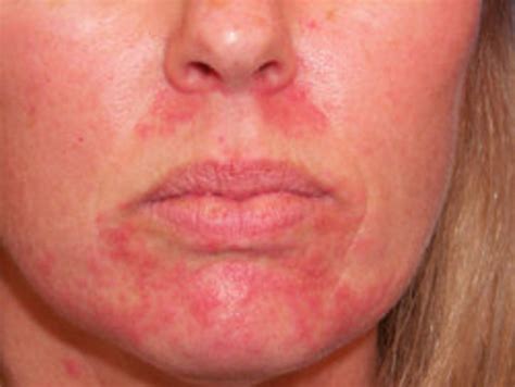 Cure Your Perioral Dermatitis Hubpages