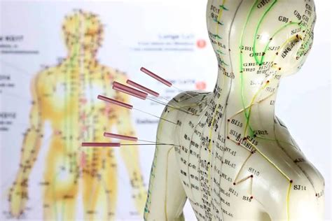 Acupuncture For Sciatica All You Need To Know Safe Sleep Systems