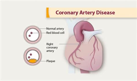 Coronary Artery Disease Cdc Gov