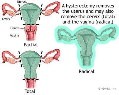 Total Vaginal Hysterectomy Vaginal Hysterectomy Hysterectomy Vaginal Hot Sex Picture