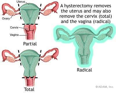 Hysterectomy Surgery Procedures Risks NY Times Health Information