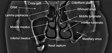 Ct Of The Nasal Cavity Coronal Section Download Scientific Diagram