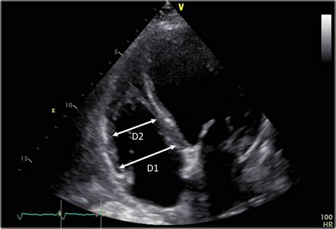 Echocardiographic Assessment Of Rv Dimensions From A Rv Focused Apical