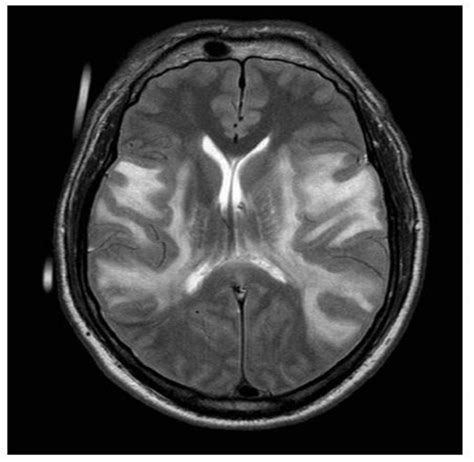 Mri Brain Axial View T2 Image Above Showing Bilateral Frontoparietal