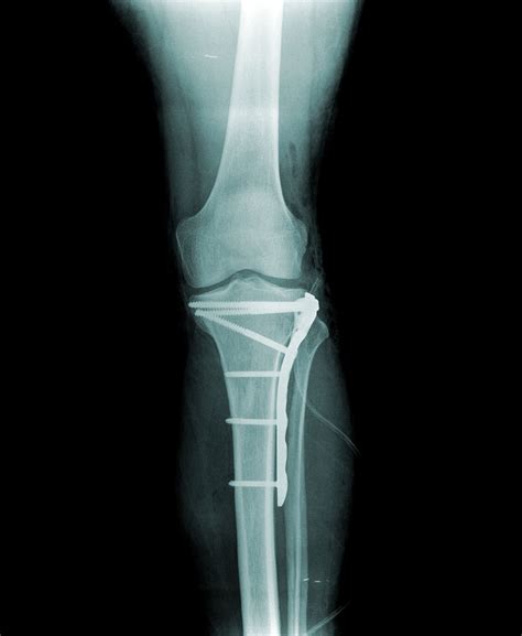 Tibial Plateau Fracture Recovery