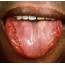 Tongue Swelling Causes Symptoms Treatment Piercing Under & One Side 