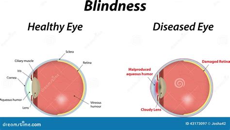 Blindness Stock Vector Illustration Of Eyes Blindness 43173097