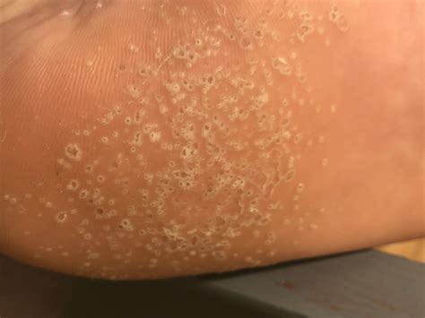 this is on the palm of my feet and sometimes on my hands. theres not