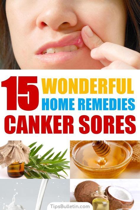 10 Home Remedies For Canker Sores Ideas Cankers Canker Sore Canker