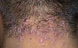 Psoriasis Hairline Home Remedies Photos