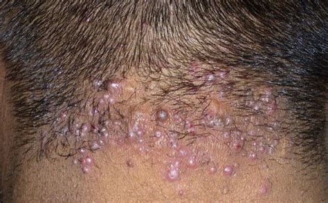 Pimples on Scalp, Causes, Small Painful, Itchy, Get Rid ...