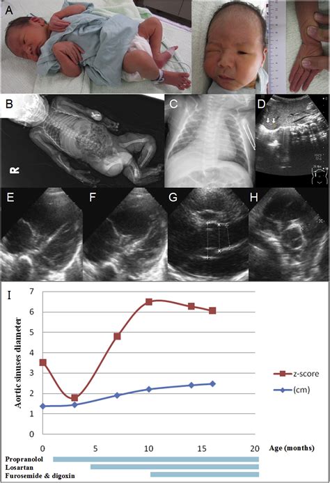 Neonatal Marfan Syndrome Life Expectancy In The Limelight E Zine Bildergalerie