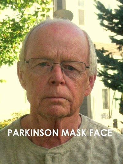 Parkinsons Disease Patient Parkinsons Masked Face Images
