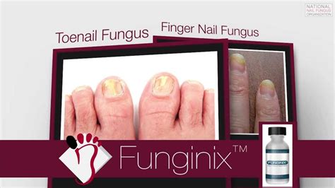 Funginix Review Toenail Fungus Treatment Review Youtube
