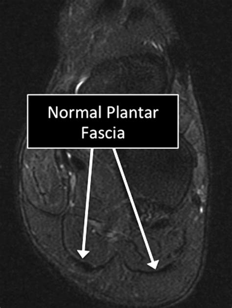A magnetic resonance imaging (mri) was performed on a normal subject; MSK MRI - Patient