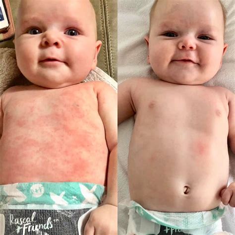 How To Manage Eczema In Babies Tell Me Baby