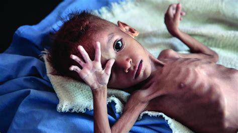 Malnutrition Forms Causes Signs And Symptoms Treatment And Prevention