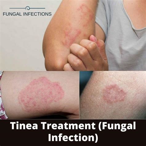 Tinea Treatment Fungal Infection Prp Treatment Center