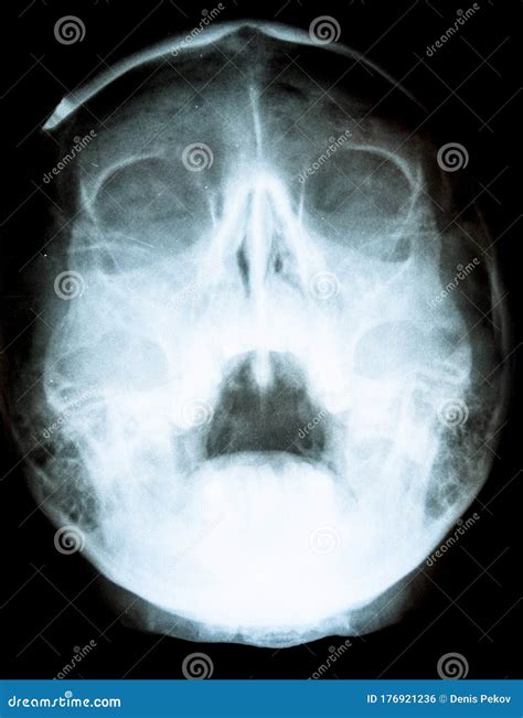X Ray Of Skull With Open Mouth Stock Photo Image Of Patient Spine