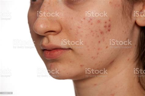 Closeup Of Teenage Girl With Problematic Skin On White Background Stock