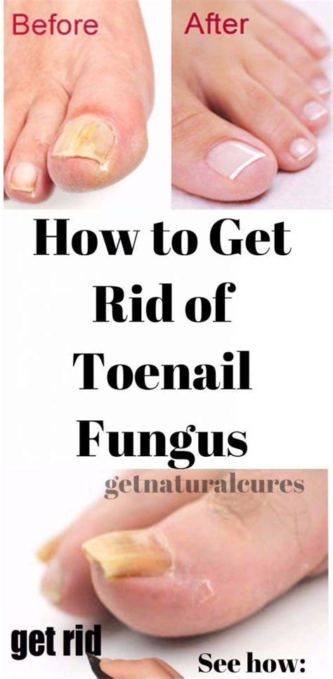 How To Get Rid Of Toenail Fungus Toenail Fungus Toenail Fungus