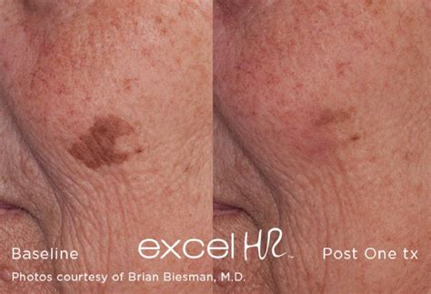 Tired Of Seeing Spots We Offer Sun Spot And Age Spot Removal Schedule Your Appointment Today