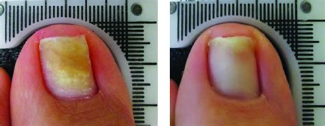 Laser Therapy For Toenail Fungus Specialist Clifton Nj Premier