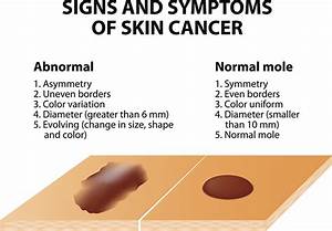 Skin Cancer - Illinois Dermatology Institute Skin Cancer  