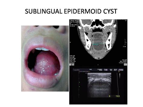 Sublingual Epidermoid Cyst Doccheck