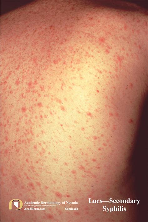 Secondary Syphilis Lues It Looks Like Pityriasis Rosea But It S Not Academic