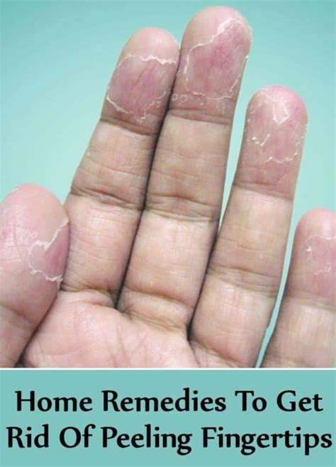 Natural Remedies For Peeling Hands That Are Really Effective All For