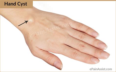 Ganglion Cyst On Hand
