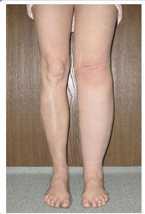 Lower Extremities Photograph Of 39 Years Old Woman After Cardiac