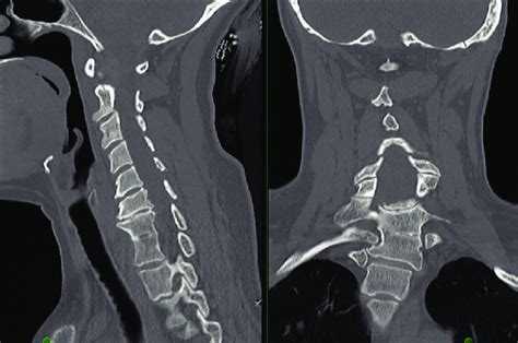 Ct Cervical Spine Revealing Of Congenital Fusion Of C7 T1 Vertebral