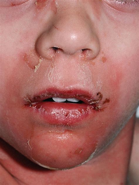 Concerning Rise Of Staphylococcal Scalded Skin Syndrome Has Us