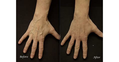 Bulging Hand Veins Permanently Removed With Rejuvahands Procedure
