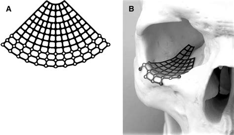 Example Of Titanium Mesh A That Can Easily Conform To The Contours Of