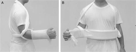 A New Method Of Immobilization After Traumatic Anterior Dislocation Of