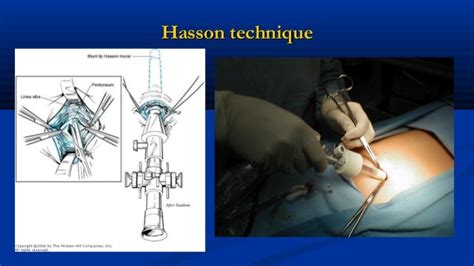 Laparoscopic Surgery Intro History Of Armata Manus Laparoscopic Sim