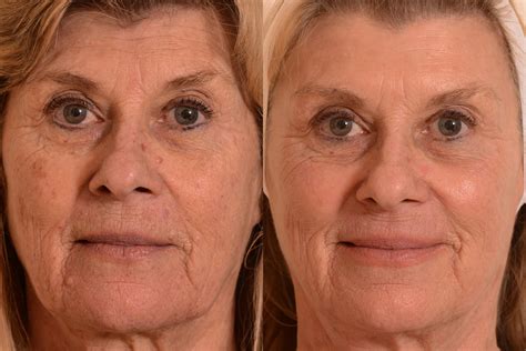 Laser Resurfacing An Infinitely Customizable Way To Improve Your Skin