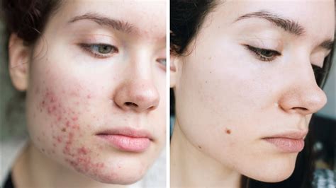 Acne Skincare Overnight Tips And Tricks How To Stop Picking Pimples