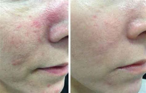 Getting treatment is a must, so make sure you see your rosacea often runs in families. IPL for Rosacea: Everything You Should Know - VIDA ...