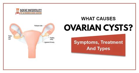 Ovary Cyst Symptoms