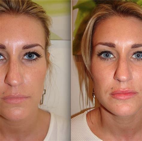 Dermarolling Before And After Face