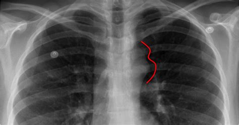 Medical Addicts Chest X Ray Coarctation Of Aorta Figure 3 Sign