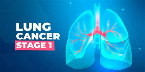Is Lung Cancer Stage 1 Curable Treatment For Lung Cancer