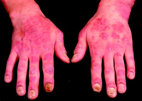 Psoriasis And Its Management The Bmj