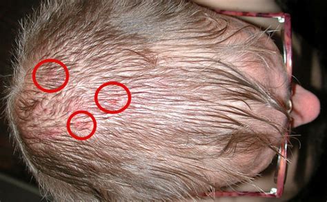 Jerawat di kepala bisa disebabkan oleh sejumlah penyakit kulit. 5 Tanaman Obat Alami Untuk Mengatasi Jerawat di Kulit Kepala
